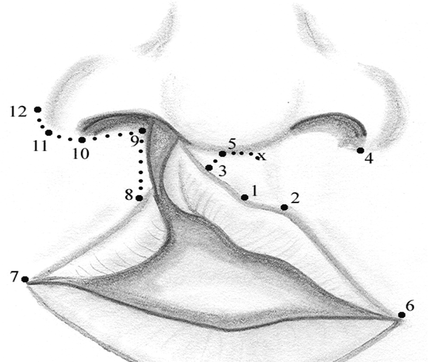 The Pharyngeal Flap Surgery Procedure