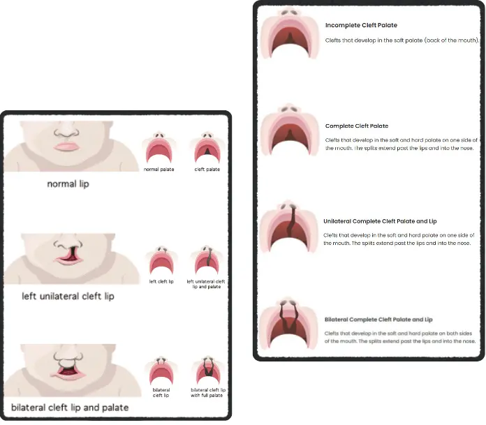 Long-Term Follow-Up For Cleft Lip And Cleft Palate Patients